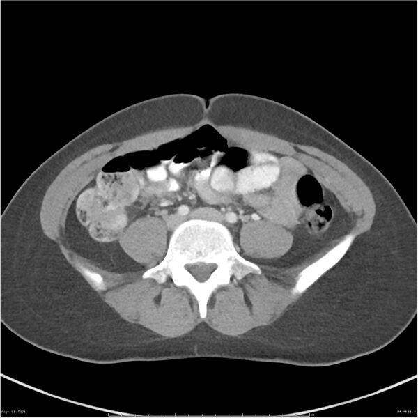 File:Bilateral ureteritis and cystitis (Radiopaedia 25340-25594 A 48).jpg