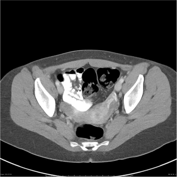 File:Bilateral ureteritis and cystitis (Radiopaedia 25340-25594 A 66).jpg