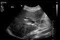 Biliary necrosis - liver transplant (Radiopaedia 21876-21843 A 4).jpg
