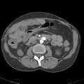 Biliary necrosis - liver transplant (Radiopaedia 21876-21845 A 30).jpg