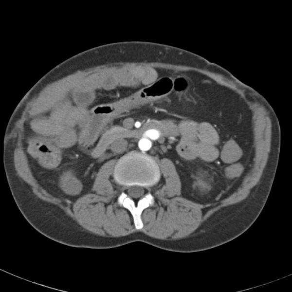 File:Biliary necrosis - liver transplant (Radiopaedia 21876-21845 A 30).jpg