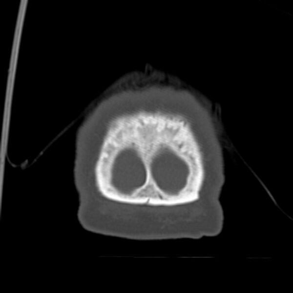 File:Biparietal osteodystrophy (Radiopaedia 46109-50463 Coronal bone window 103).jpg