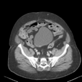 Bladder papillary urothelial carcinoma (Radiopaedia 48119-52951 Axial 44).png