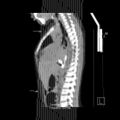 Bochdalek diaphragmatic hernia (Radiopaedia 38866-41059 Coronal liver window 21).jpg