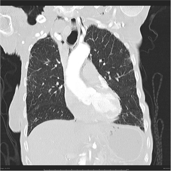 File:Boerhaave syndrome (Radiopaedia 26240-26362 Coronal lung window 12).jpg