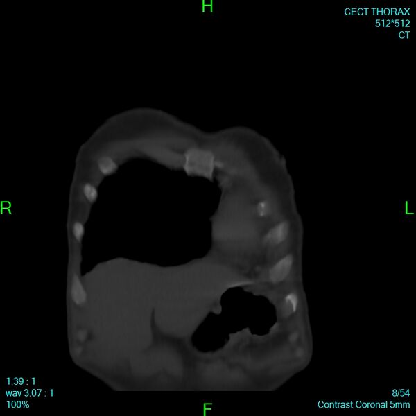 File:Bone metastases from lung carcinoma (Radiopaedia 54703-60937 Coronal bone window 8).jpg
