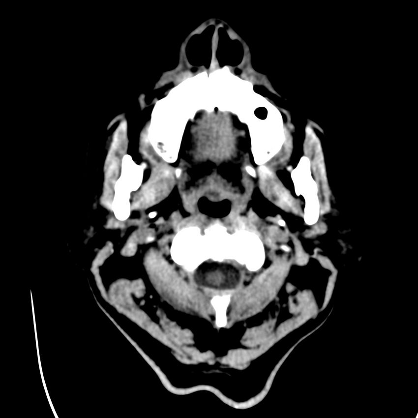 Brain Pantopaque remnants (Radiopaedia 78403-91048 Axial non-contrast 4).jpg
