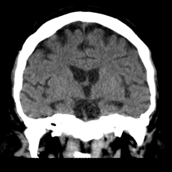 File:Brain cortical laminar necrosis (Radiopaedia 25822-25971 C 27).jpg