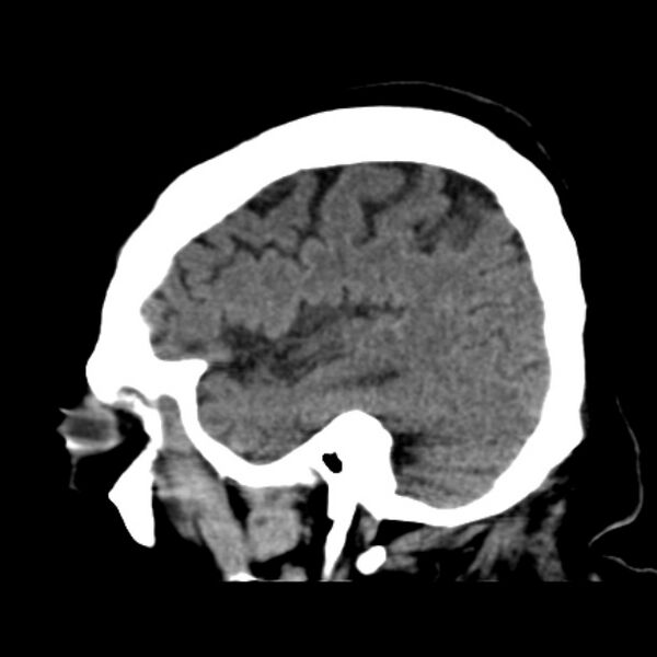 File:Brain cortical laminar necrosis (Radiopaedia 25822-25971 non-contrast 13).jpg
