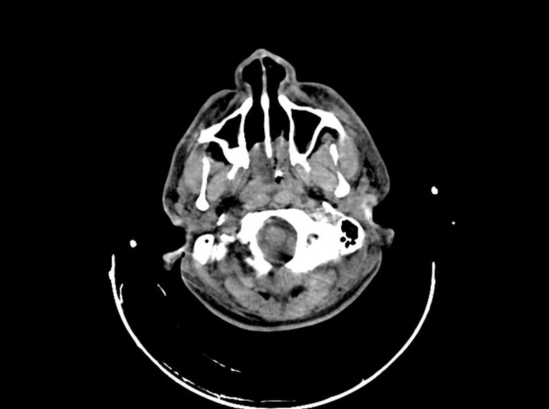File:Brain injury by firearm projectile (Radiopaedia 82068-96087 B 42).jpg