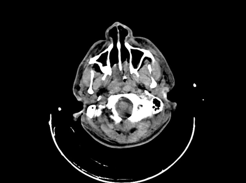 Brain injury by firearm projectile (Radiopaedia 82068-96087 B 42).jpg