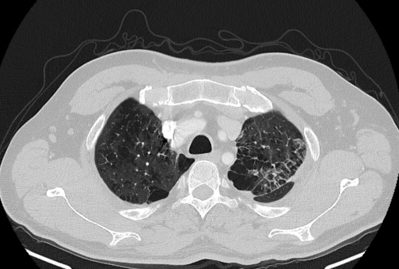 File:Brain metastases - lung cancer primary (Radiopaedia 75060-86116 Axial lung window 8).jpg