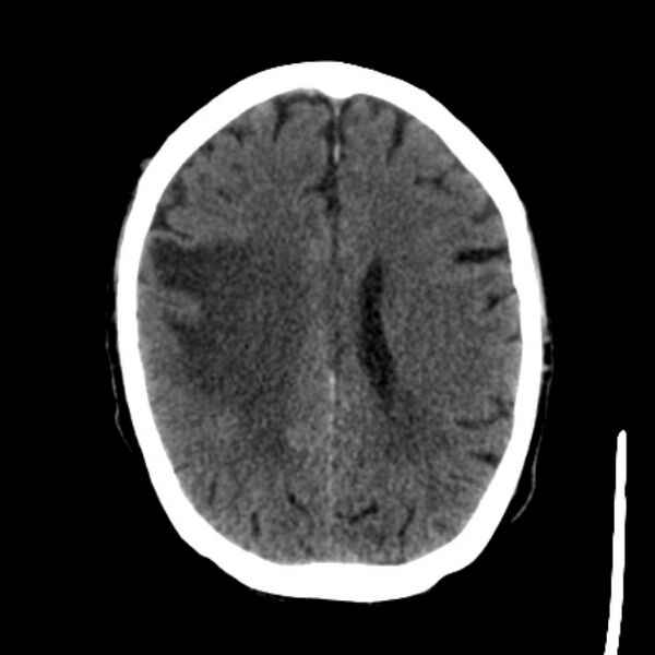 File:Brain metastases from lung cancer (Radiopaedia 27849-28092 Axial non-contrast 30).jpg