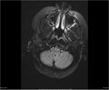 Brainstem glioma (Radiopaedia 21819-21775 Axial FLAIR 6).jpg