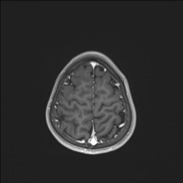 File:Brainstem glioma (Radiopaedia 70548-80674 Axial T1 C+ 134).jpg