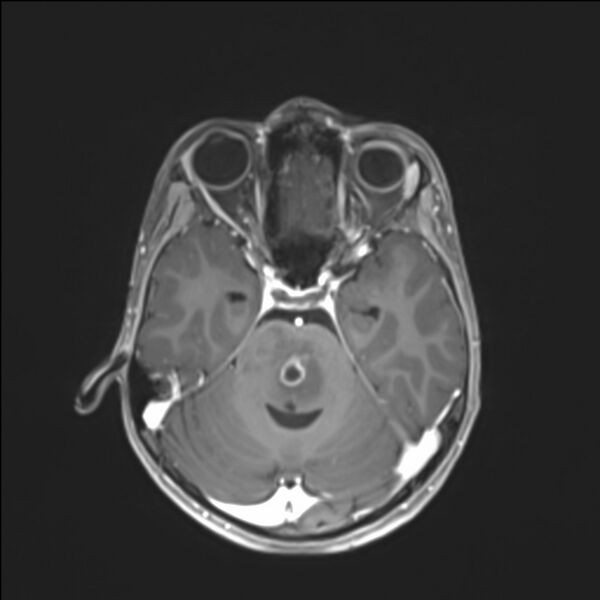 File:Brainstem glioma (Radiopaedia 70548-80674 Axial T1 C+ 56).jpg