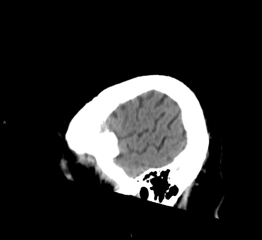 Brainstem hemorrhage (Radiopaedia 58794-66028 C 45).jpg
