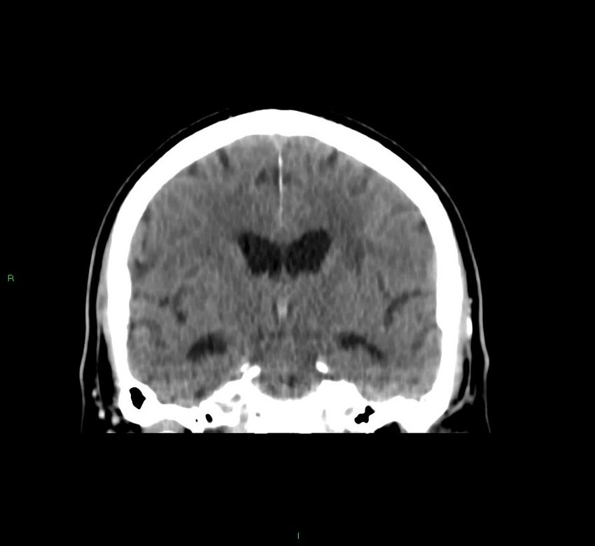 Brainstem hemorrhage (Radiopaedia 58794-66028 Coronal non-contrast 35).jpg