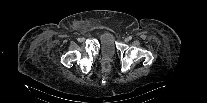 File:Breast cancer pelvic bony metastases (Radiopaedia 84470-99824 Axial bone window 62).jpg