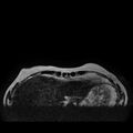Breast implants - MRI (Radiopaedia 26864-27035 Axial T2 1).jpg