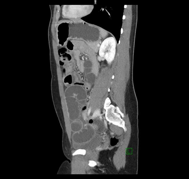 File:Broad ligament hernia (Radiopaedia 63260-71832 C 35).jpg