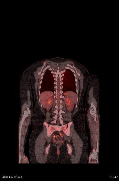 File:Brown fat uptake (FDG PET-CT) (Radiopaedia 77392-89513 Fused coronal 75).jpg