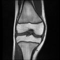 Bucket handle tear - lateral meniscus (Radiopaedia 72124-82634 Coronal T1 8).jpg