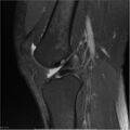Bucket handle tear - lateral meniscus (Radiopaedia 7246-8187 Sagittal T2 fat sat 13).jpg