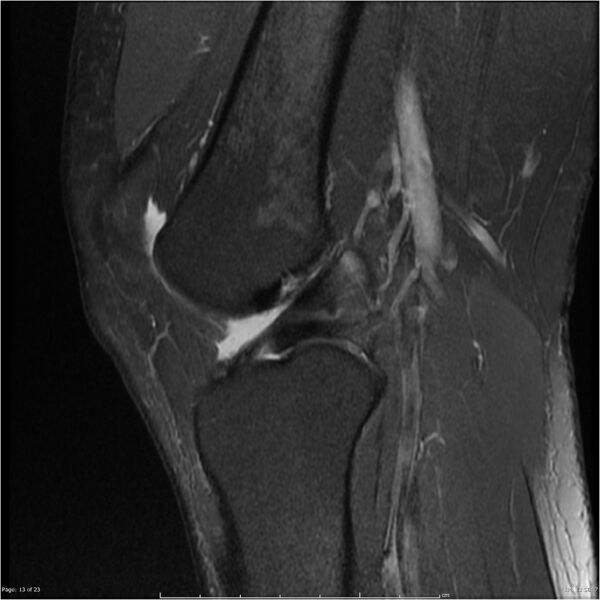 File:Bucket handle tear - lateral meniscus (Radiopaedia 7246-8187 Sagittal T2 fat sat 13).jpg