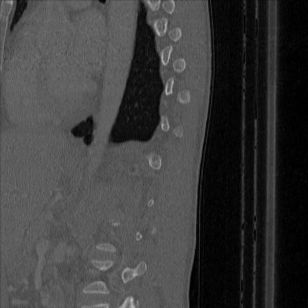 File:Bulging of paraspinal line in traumatic thoracal spinal compression fracture (Radiopaedia 29221-35872 Sagittal bone window 50).jpg