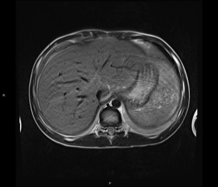 File:Burkitt lymphoma (bowel) (Radiopaedia 68839-78557 Axial T2 10).jpg