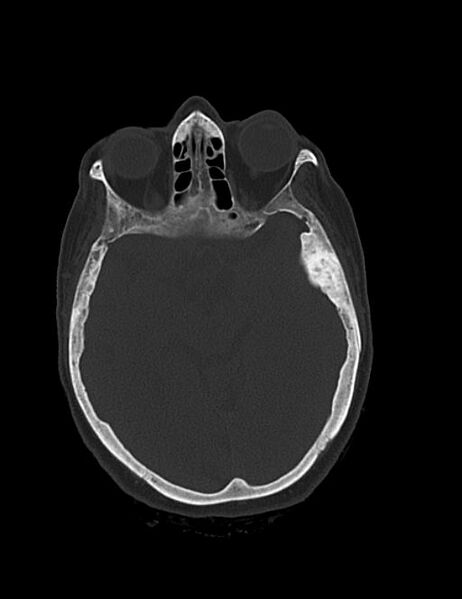 File:Burnt-out meningioma (Radiopaedia 51557-57337 Axial bone window 20).jpg