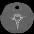 C5 facet fracture (Radiopaedia 58374-65499 Axial bone window 70).jpg
