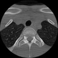 C5 facet fracture (Radiopaedia 58374-65499 Axial bone window 97).jpg