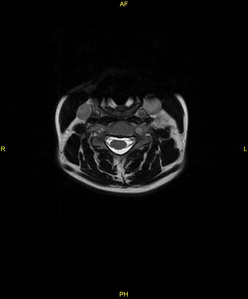 File:C5 nerve sheath tumor (Radiopaedia 85777-101596 Axial T2 30).jpg