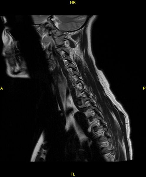 File:C5 nerve sheath tumor (Radiopaedia 85777-101596 Sagittal T2 7).jpg