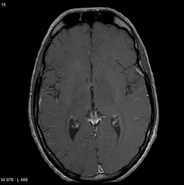 File:CMV ventriculitis and encephalitis (Radiopaedia 5416-7166 Axial T1 C+ 4).jpg