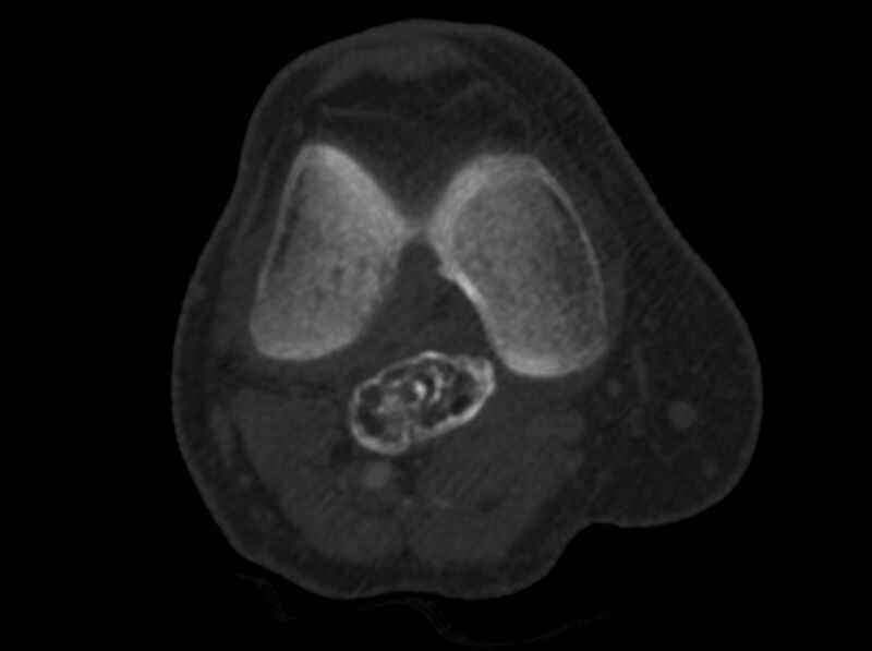 File:Calcified hematoma - popliteal fossa (Radiopaedia 63938-72763 C 14).jpg