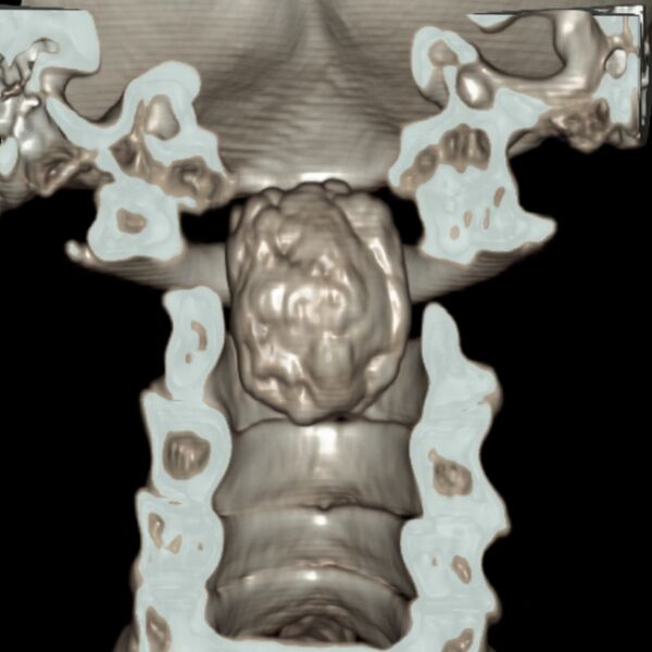File:Calcified meningioma - cervical canal (Radiopaedia 70136-80171 3D-VR 5).jpg
