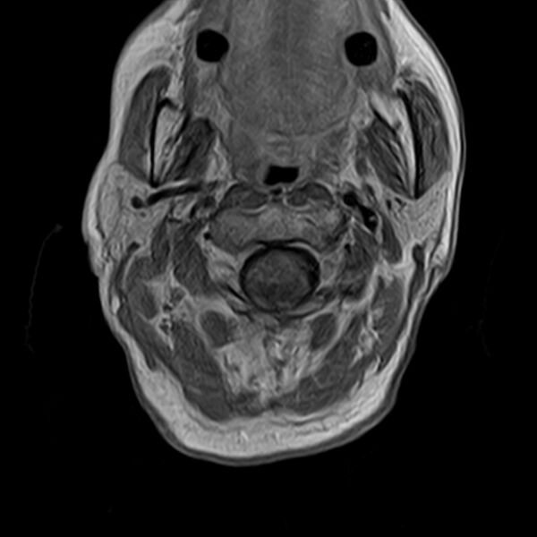 File:Calcified meningioma - cervical canal (Radiopaedia 70136-82468 Axial T1 C+ 9).jpg