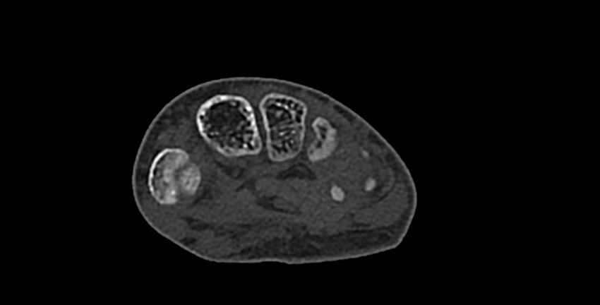 Calcifying aponeurotic fibroma (Radiopaedia 88423-105064 Axial bone window 123).jpg