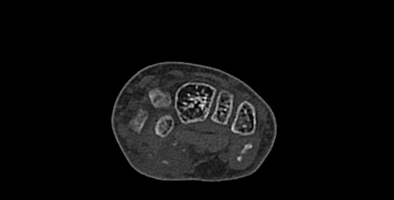 File:Calcifying aponeurotic fibroma (Radiopaedia 88423-105064 Axial bone window 79).jpg