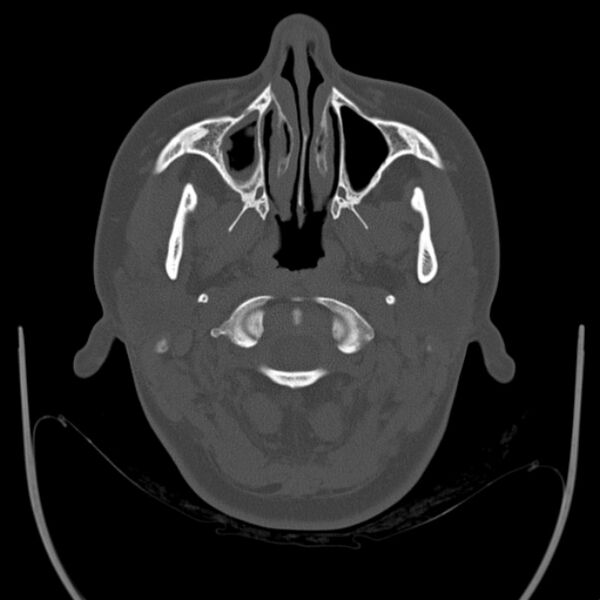 File:Calvarial osteoma (Radiopaedia 36520-38079 Axial bone window 7).jpg
