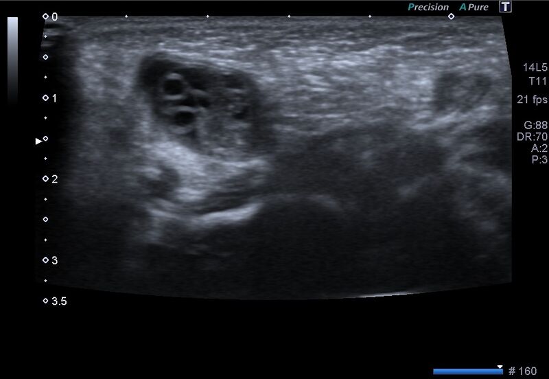 File:Canal of Nuck hernia - bilateral ovaries (Radiopaedia 57930-64900 C 1).jpg