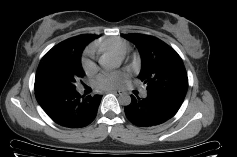 File:Cannonball metastases - uterine choriocarcinoma (Radiopaedia 70137-80173 Axial non-contrast 55).jpg