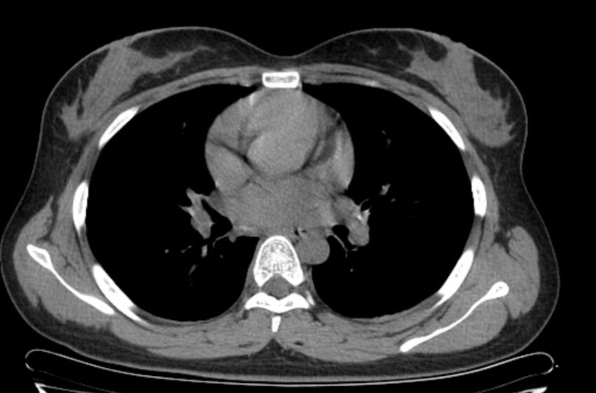 Cannonball metastases - uterine choriocarcinoma (Radiopaedia 70137-80173 Axial non-contrast 55).jpg