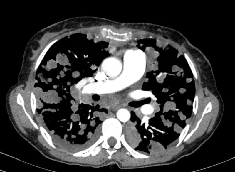 File:Cannonball metastases from breast cancer (Radiopaedia 91024-108569 A 58).jpg