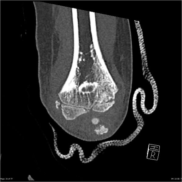 File:Capitellum fracture (Radiopaedia 23352-23426 Coronal bone window 21).jpg