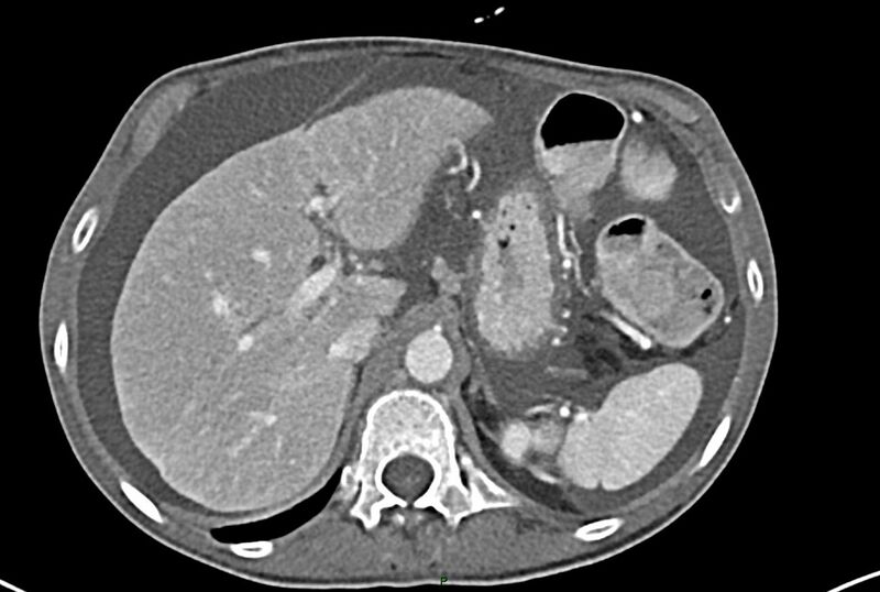 File:Carcinoid mesenteric tumor complicated by chylous ascites (Radiopaedia 76312-87953 A 16).jpg
