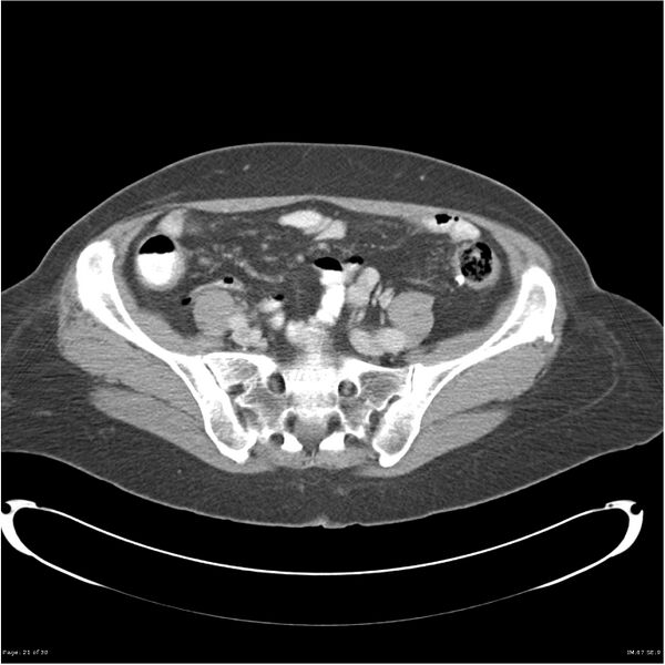 File:Carcinoid tumor of the ileum with metastasis to orbit (Radiopaedia 28165-28425 A 21).jpg